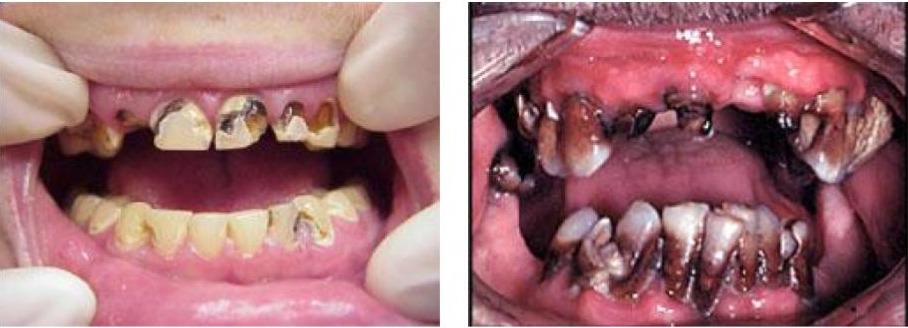 Photo of two damaged dentures